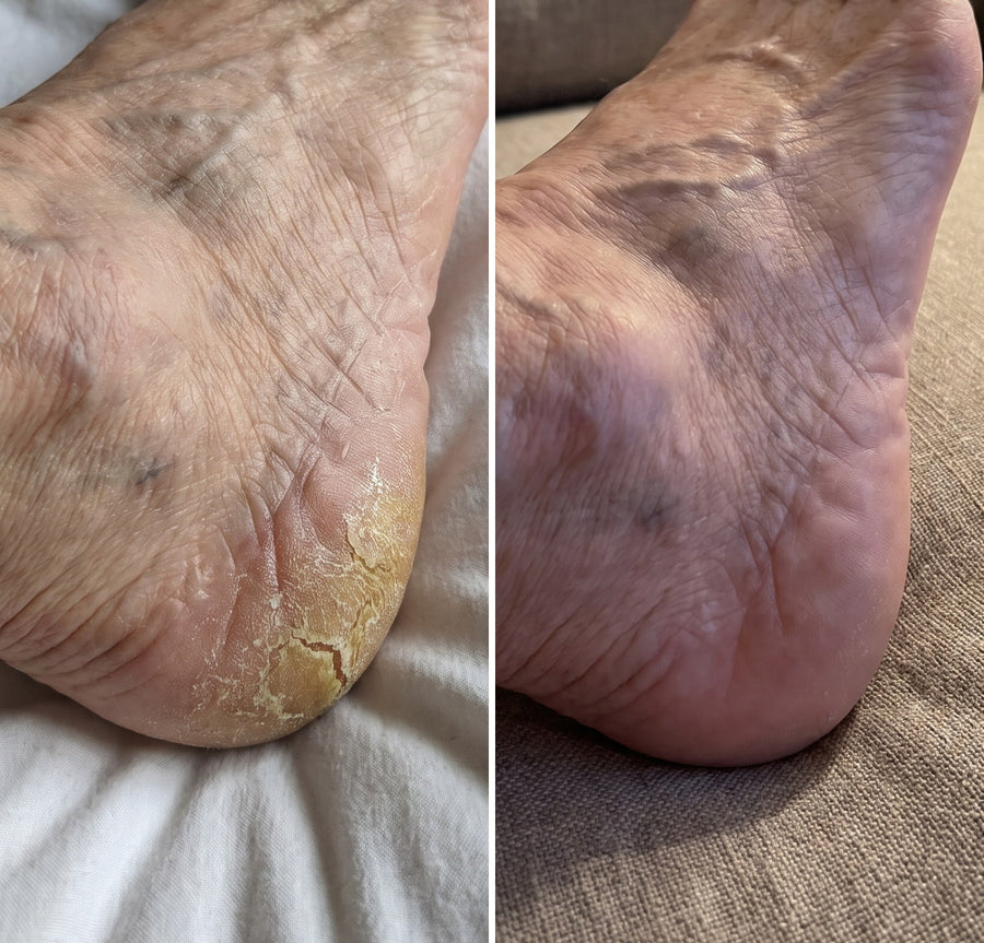 Before and after of an elderly woman's cracked heel, one month apart