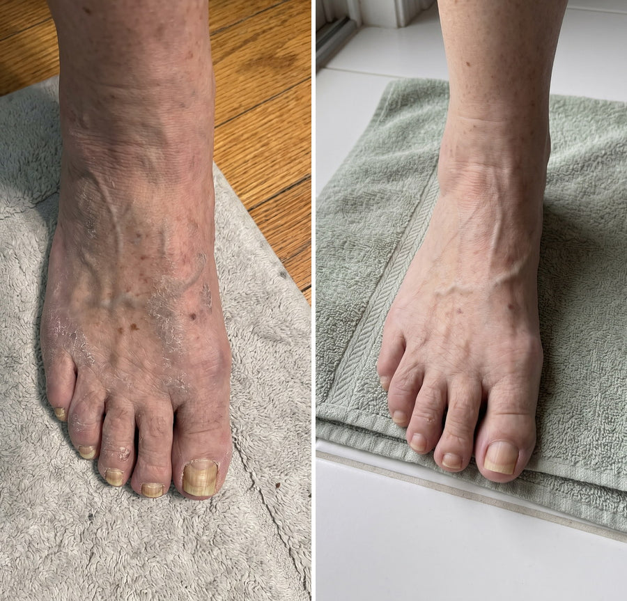 Before and after of dry flaking skin on the top of an elderly woman's foot