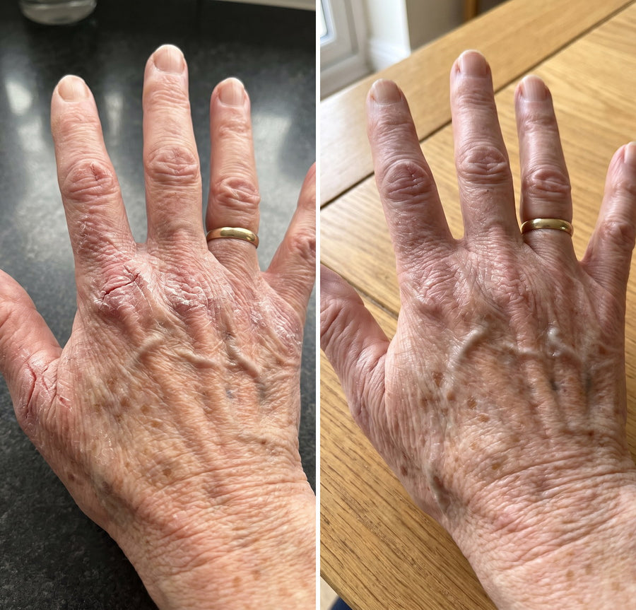 Before and after of chapped knuckles on the back of an elderly woman's hand