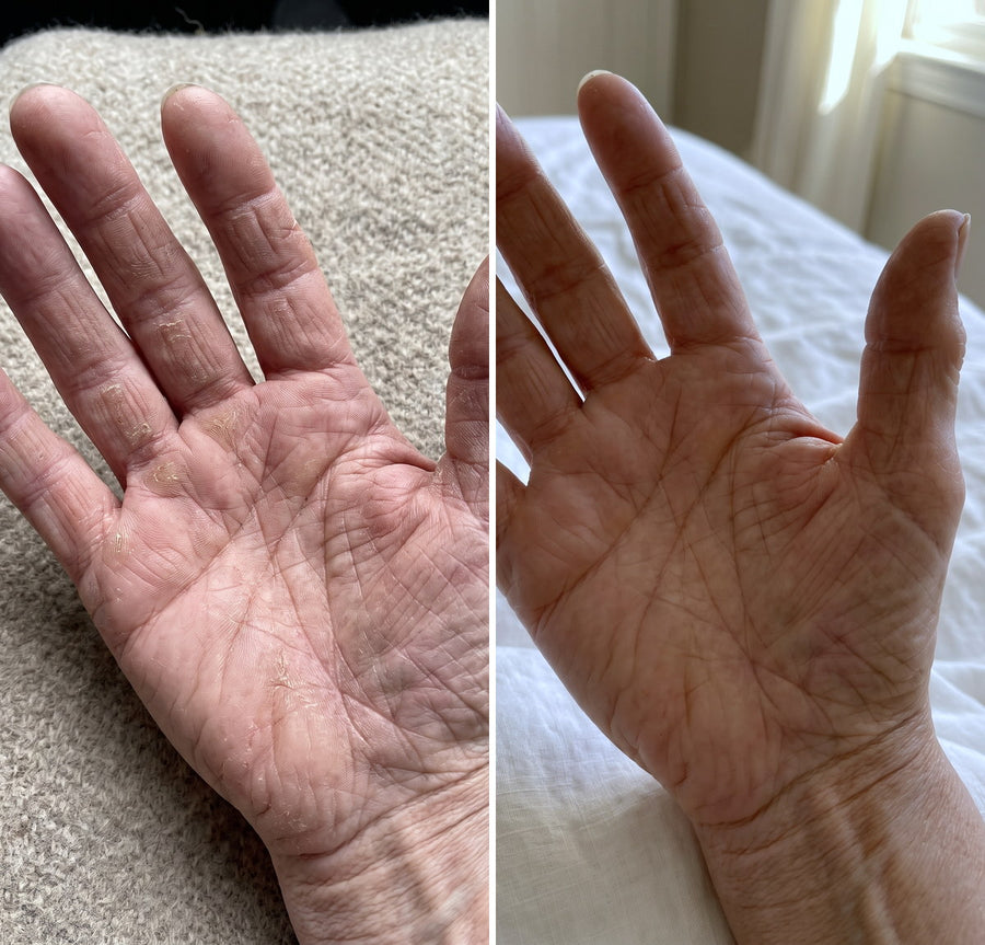 Before and after of split fingertips on an elderly woman's palm