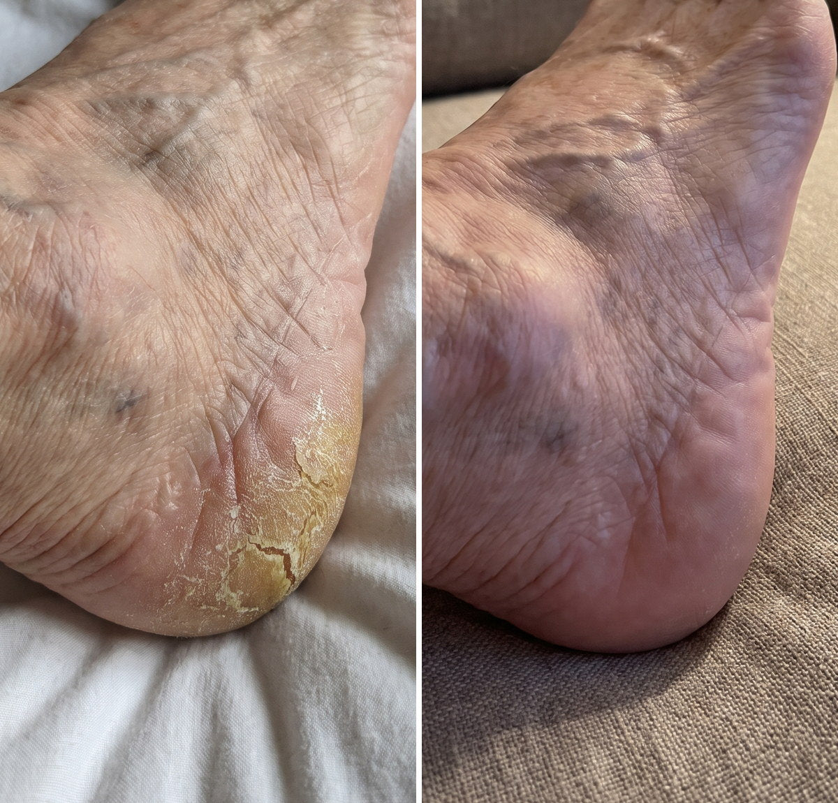 Before and after of an elderly woman's cracked heel, one month apart